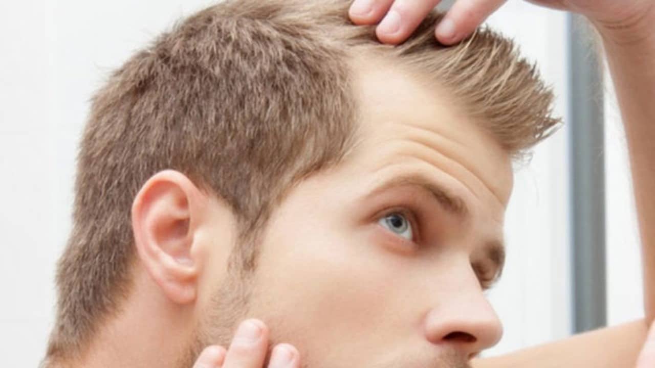 La perte de cheveux chez l'homme à 20 ans