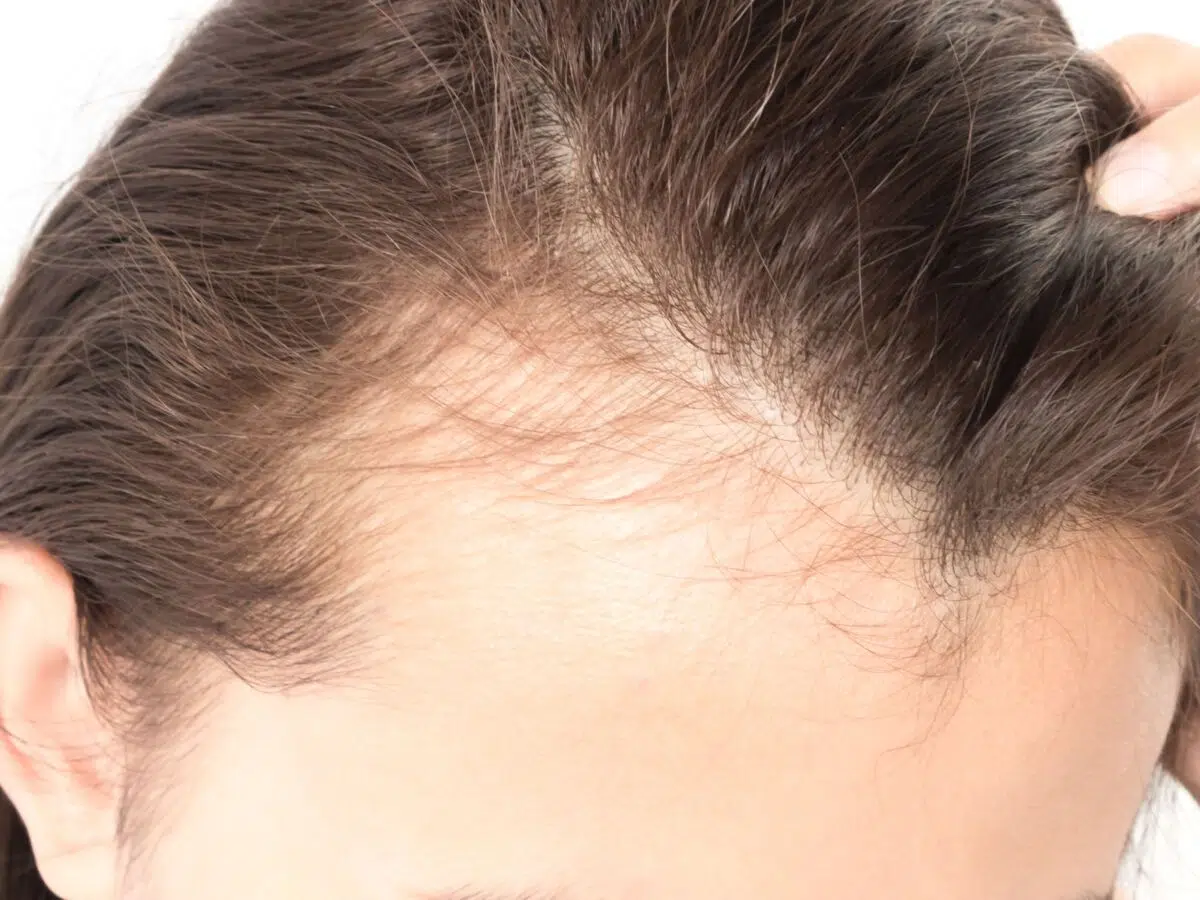 Perte de densité cheveux chez l'homme