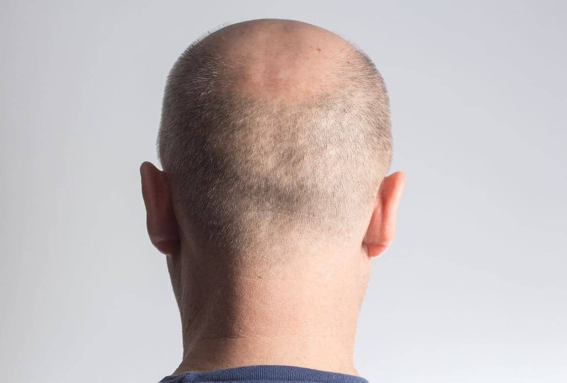Quels sont les meilleurs remèdes pour la perte de cheveux chez l'homme ?
