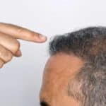 Comment lutter contre la chute de cheveux chez les hommes ?